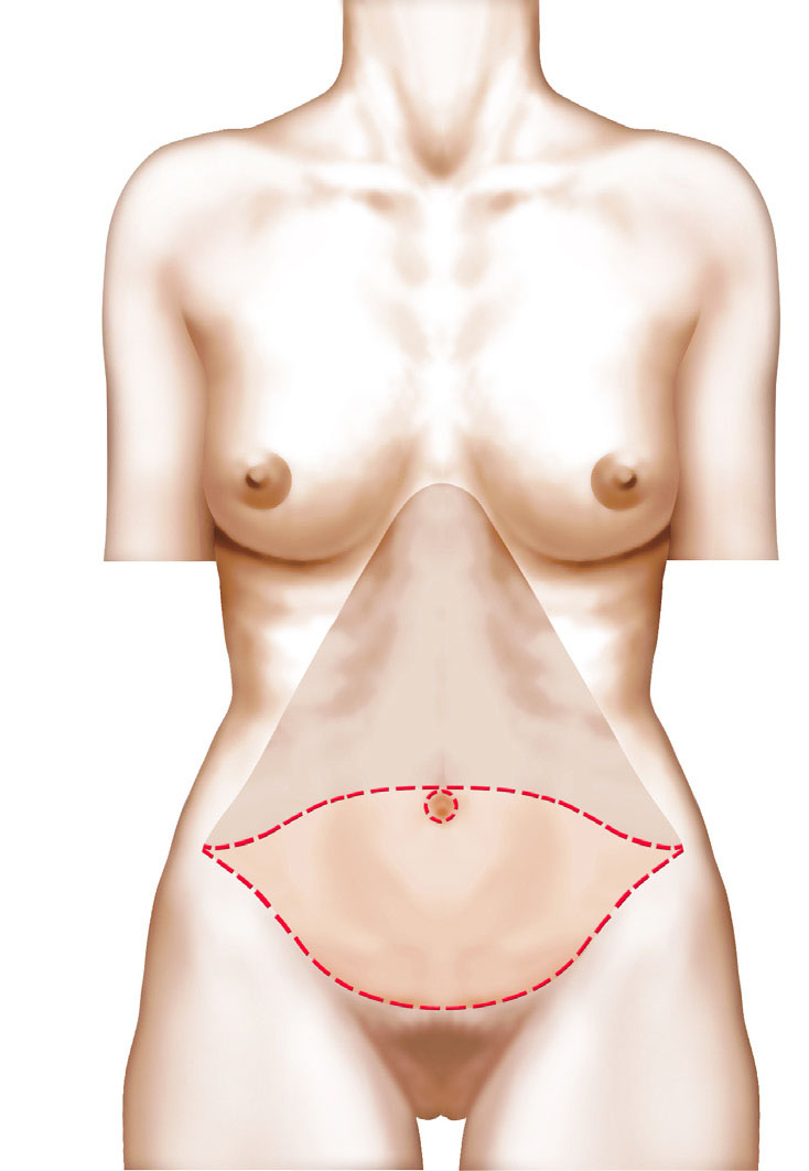 Gaine après abdominoplastie - Culotte haute pour liposuccion ventre 